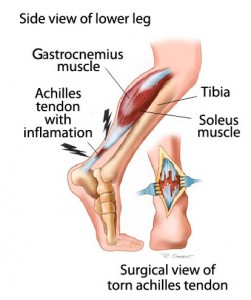calcaneal tendonitis treatment
