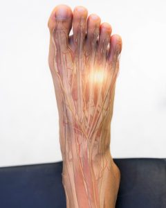 image of foot showing faded bone outlines and highlighting the area the neuroma is usually found