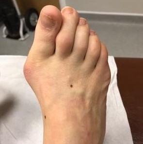 Bunion Correction