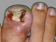 Do you really have an ingrowing toenail?